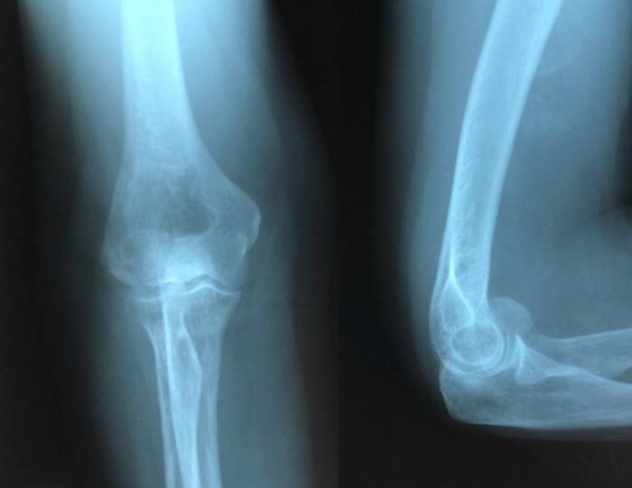 Перелом дистального метаэпифиза лучевой кости (перелом лучевой кости «в типичном месте»)