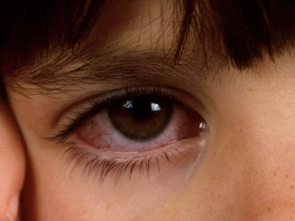 Почему глаза краснеют при конъюнктивите?
