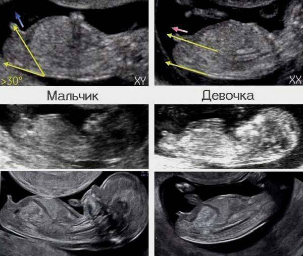 Беременность мальчиком и девочкой: отличия, фото / форма живота и пол будущего ребенка