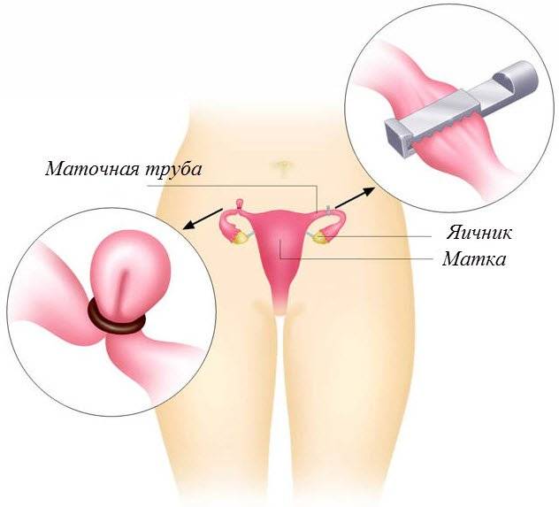 Сделать перевязку маточных труб – стоимость операции по перевязыванию труб — медицинский женский центр в москве