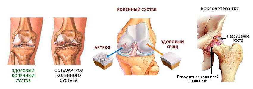 Что такое бурсит колена и как его лечить
