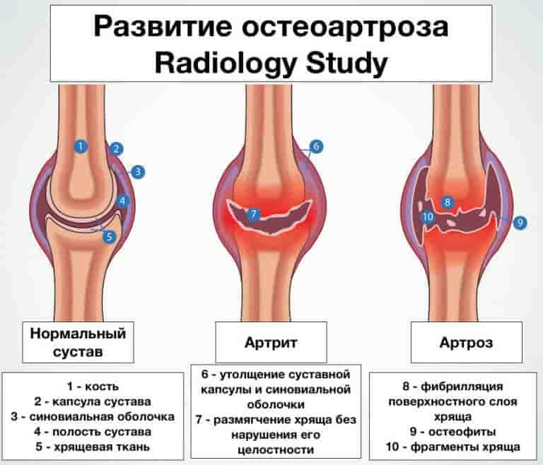 Остеопороз суставов: лечение, симптомы, виды и диагностика