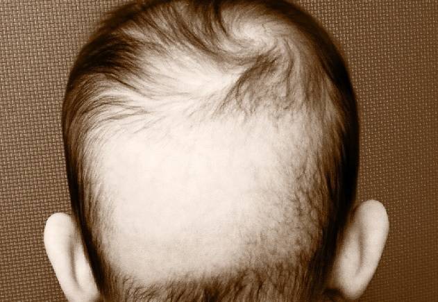 Почему выпадают волосы у подростка девочки? – публикации – лаборатория ан-тек