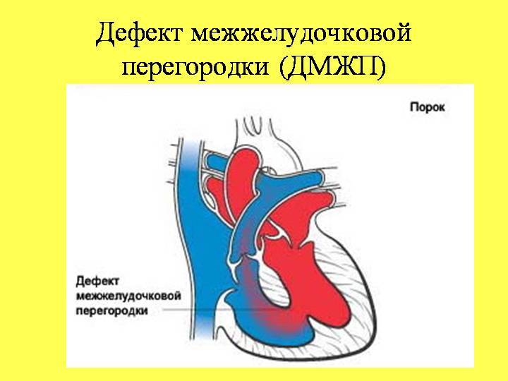 Межжелудочковая перегородка. ДМЖП гемодинамика. Гемодинамика порока межжелудочковой перегородки. Приточный мышечный дефект межжелудочковой перегородки.