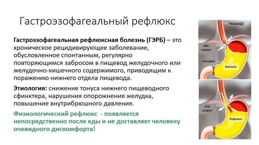 ᐈ диагностика и лечение гастроэзофагеальной рефлюксной болезни (гэрб)