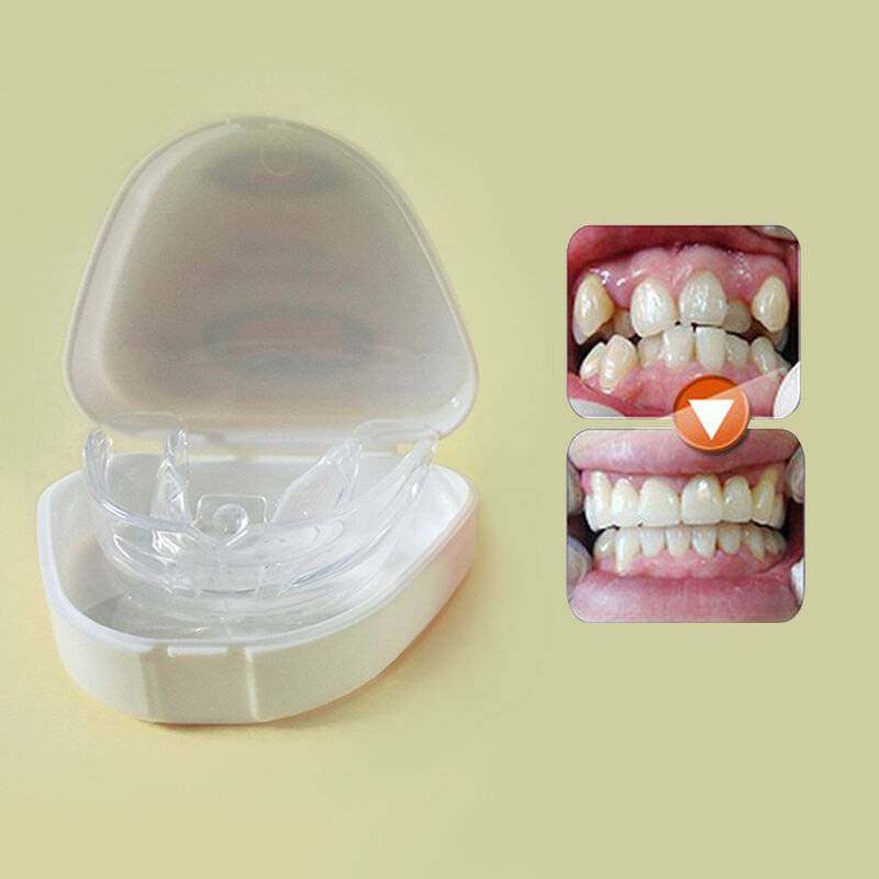 Пластинки для выравнивания зубов у детей: фото, установка, другие конструкции