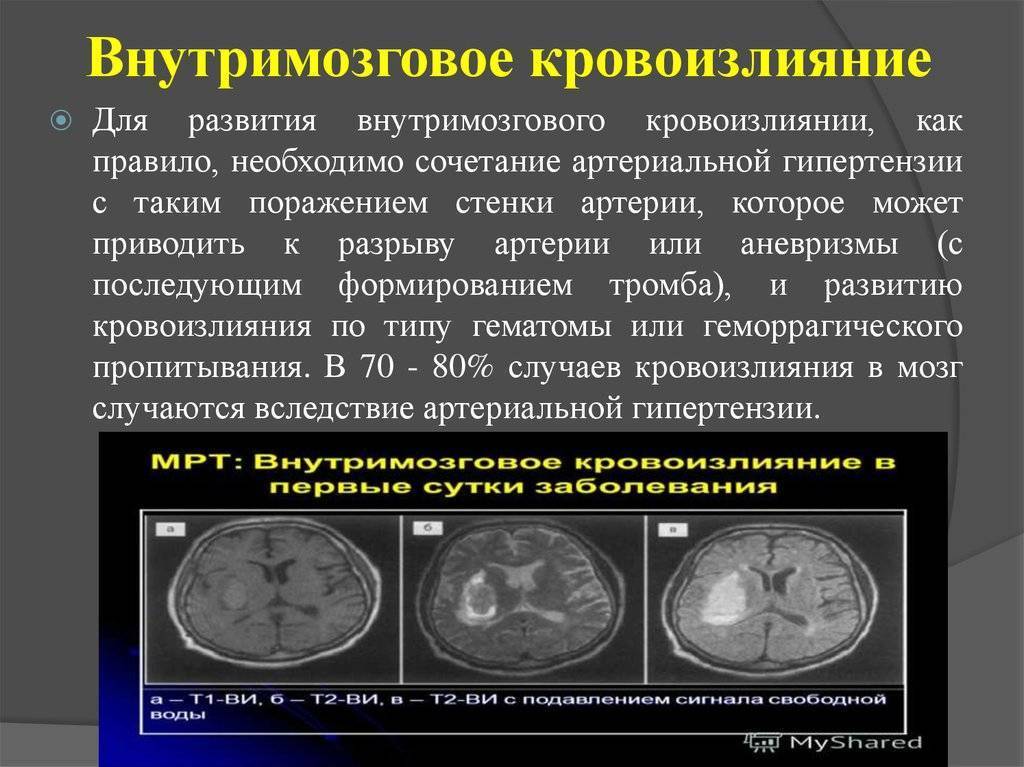 Лобный синусит (фронтит)