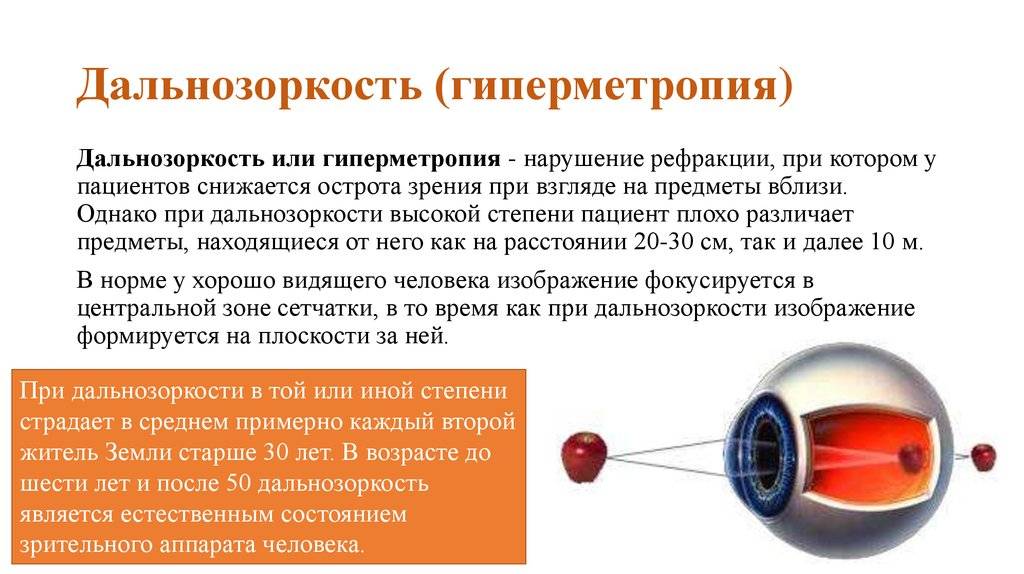Лечение дальнозоркости (гиперметропии): профилактика, диагностика и коррекция