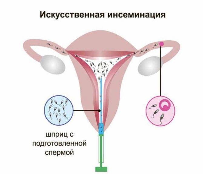 Искусственная инсеминация спермой мужа (иисм) или донора (иисд) в москве | внутриматочная искусственная инсеминация в клинике «линия жизни»