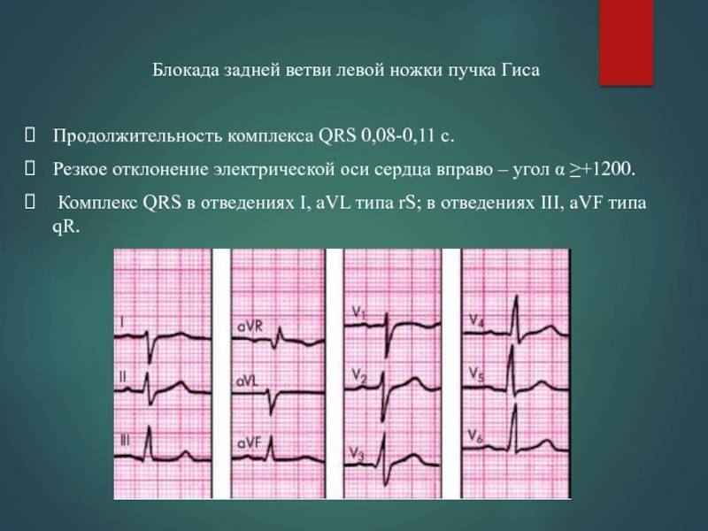 Блокада левого переднего пучка гиса. Неполная блокада задней ветви ЛНПГ. Блок левой ножки пучка Гиса на ЭКГ. Неполная блокада передней ветви левой ножки пучка Гиса на ЭКГ. ЭКГ при блокаде левой задней ветви пучка Гиса.