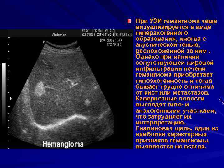 Гепатомегалия -  hepatomegaly
