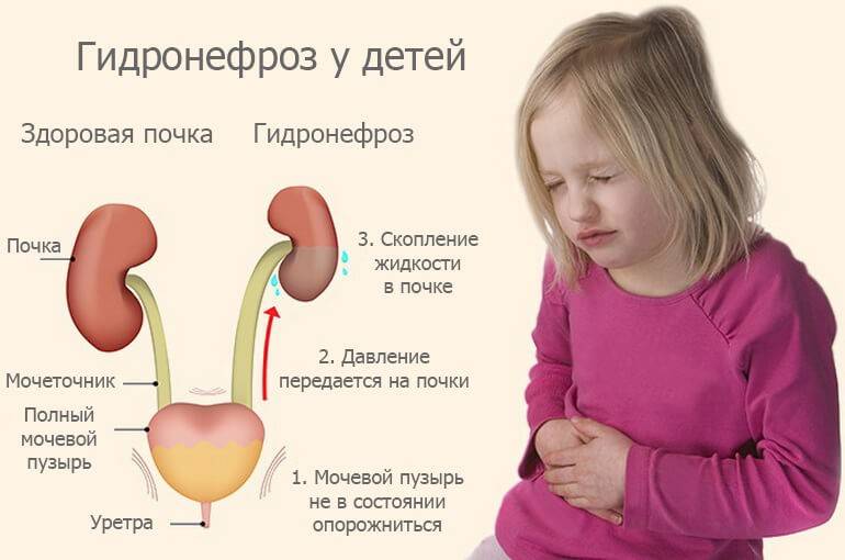 ▶лечение гидронефроза почки у детей в киеве ✅мц adonis