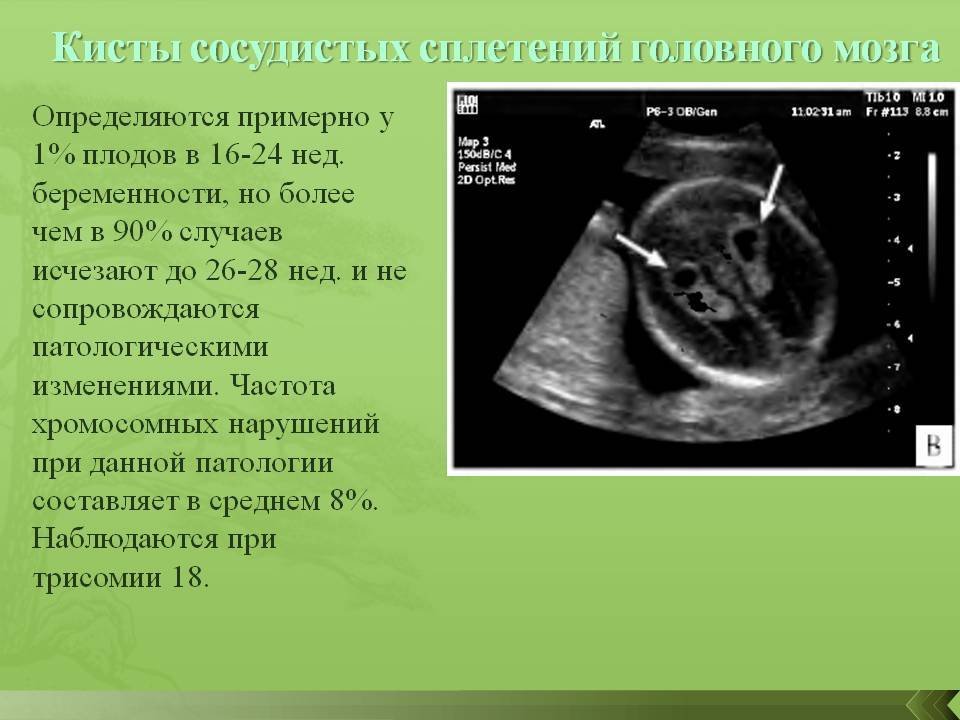 Кровоток в артерии пуповины норма — 25 рекомендаций на babyblog.ru