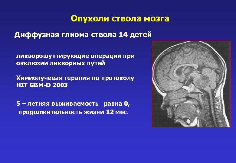 Глиома головного мозга
