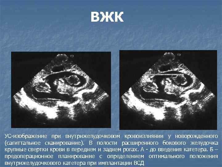 Кровоизлияние в желудочки головного мозга