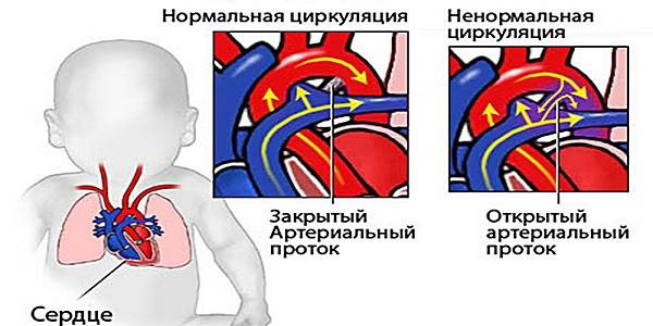 Шумы в сердце у ребенка: причины систолического, функционального шума в 1-3 года
