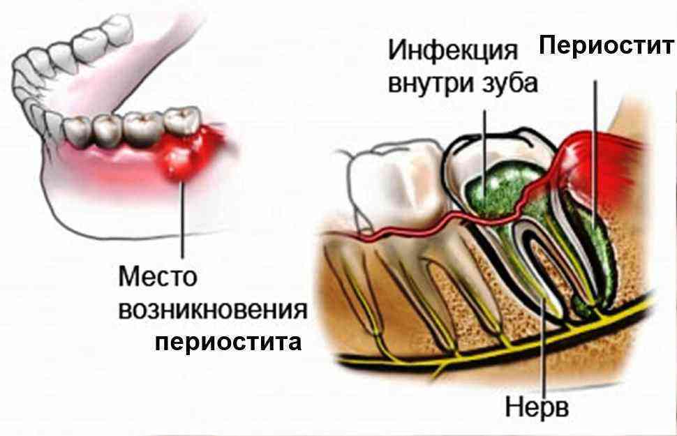 Лечение периодонтита у детей - лечение периодонтита молочных зубов. народные методы лечения