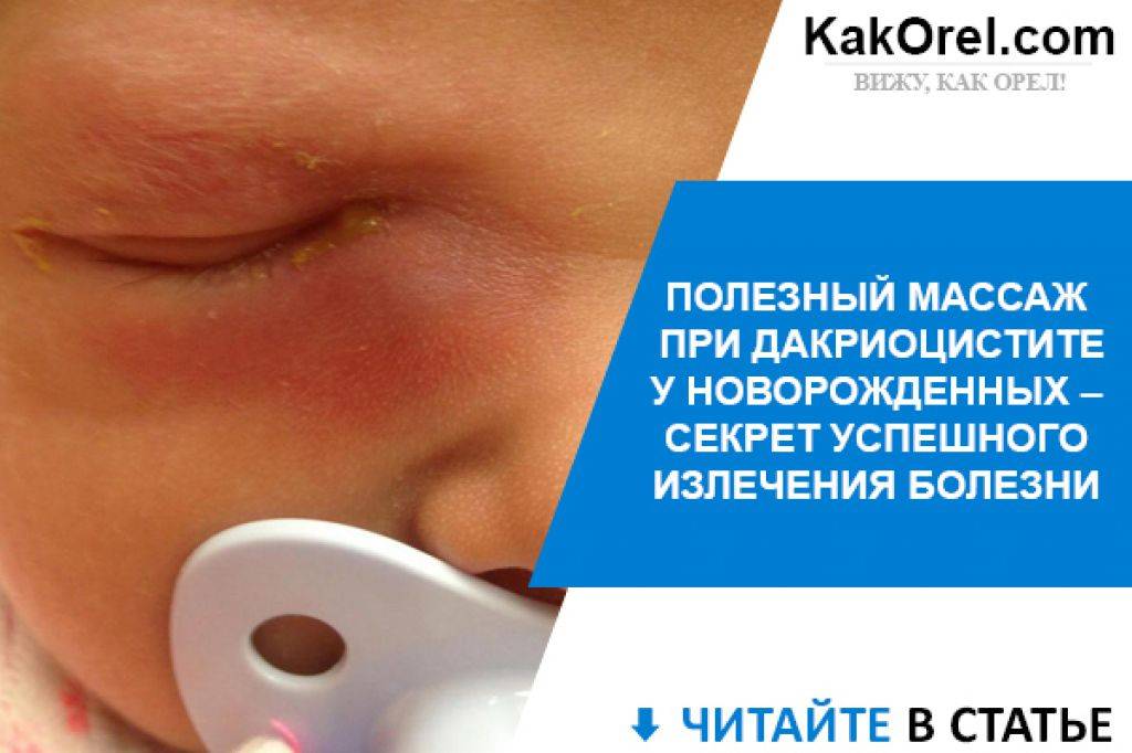 Дакриоцистит у новорожденных: советы доктора комаровского