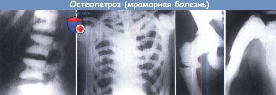 Остеопетроз (мраморная болезнь) у детей - medside.ru