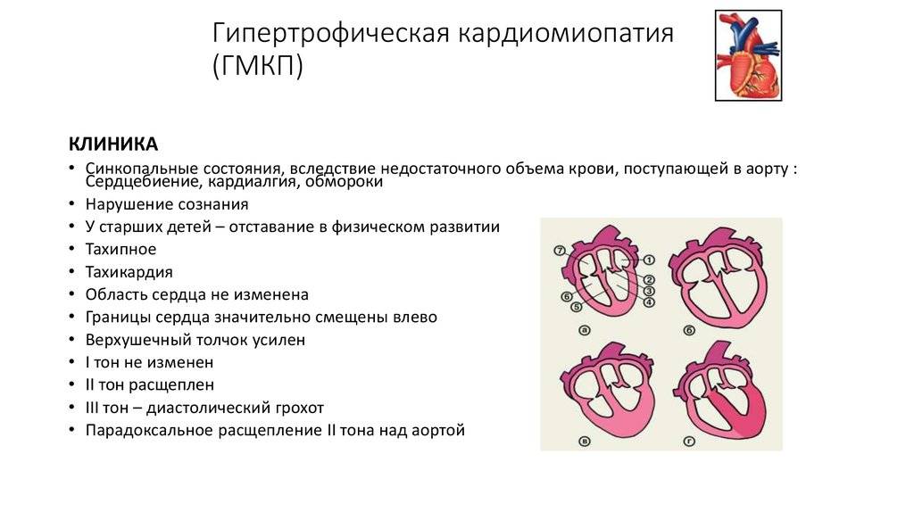 Кардиопатия у детей и взрослых, что это такое