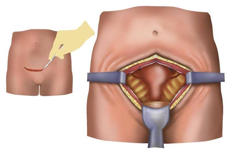 Последствия перевязки маточных труб при кесаревом сечении