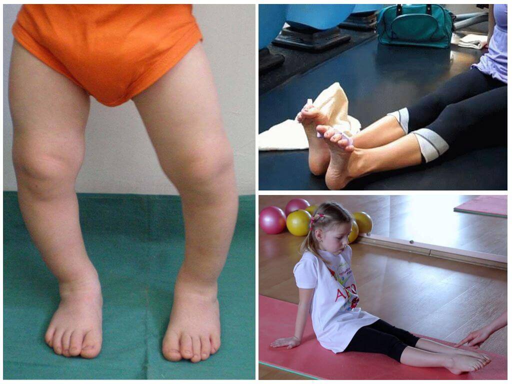 Врожденные и приобретенные деформации стопы у детей