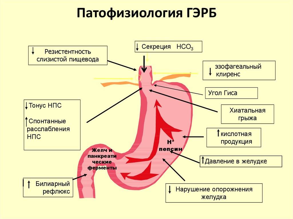 Желудочно-пищеводный рефлюкс – мастер маскировки