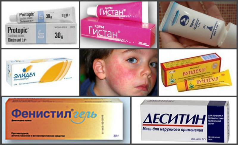 Топ-13 препаратов от аллергии (антигистаминных) - рейтинг хороших средств 2021