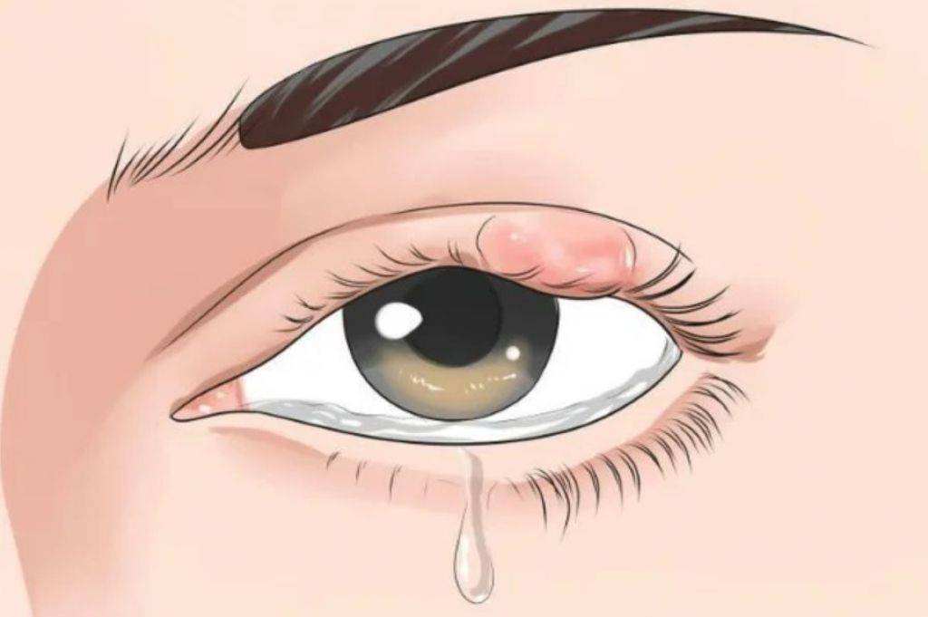 Как лечить ячмень на глазу: от заварки до тетрациклиновой мази