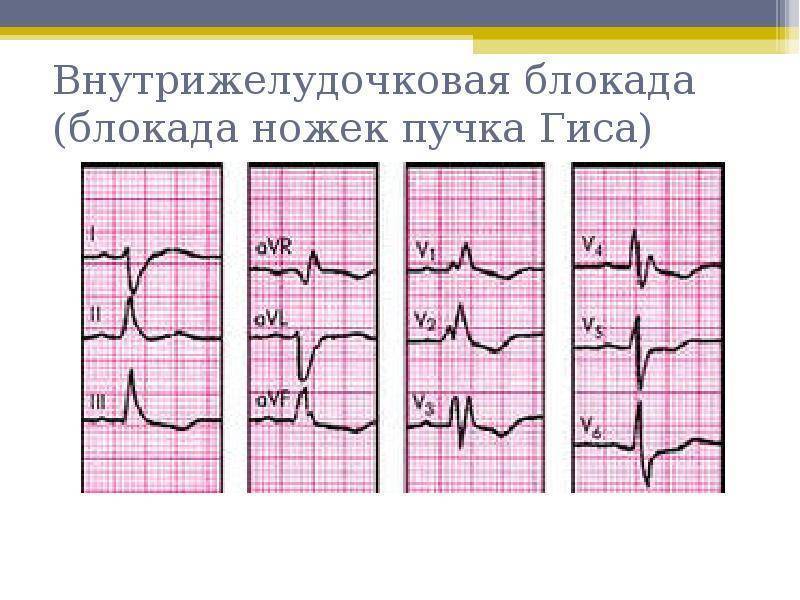 Нарушение внутрижелудочковой проводимости сердца у детей на ЭКГ: что это и как лечится?