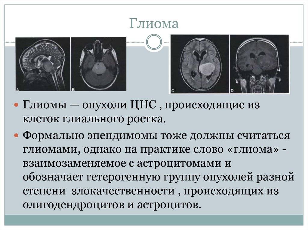 Опухоли ствола мозга - симптомы болезни, профилактика и лечение опухолей ствола мозга, причины заболевания и его диагностика на eurolab
