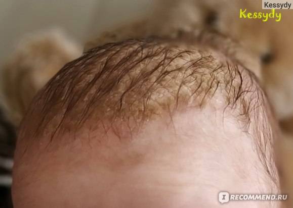 Корочка на голове у ребенка | pampers ru