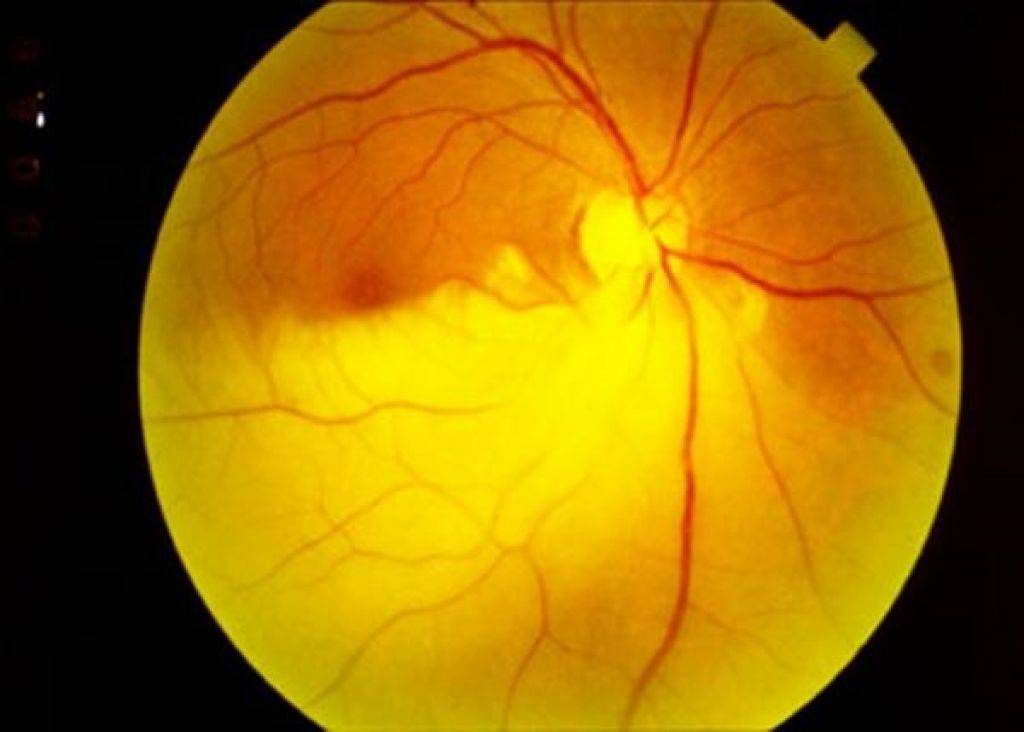 Сужение сосудов глаз. Острая непроходимость центральной артерии сетчатки (цас).. Тромбоз цас глазное дно. Эмболия центральной артерии сетчатки.