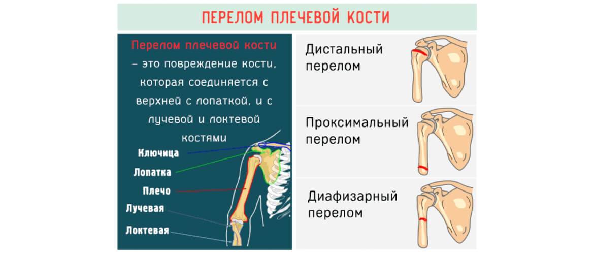 Место кости. Перелом головчатого возвышения плечевой кости. Типичное место перелома плечевой кости. Место наиболее частых переломов плечевой кости. Лечение перелома проксимальной части плечевой кости.