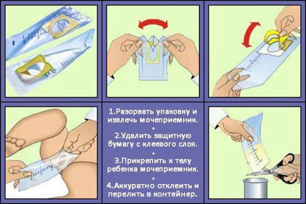 Как собрать мочу у новорожденного. Алгоритм забора мочи на исследование. Сбор мочи у детей алгоритм. Сбор анализа мочи. Сбор мочи на общий анализ у детей.