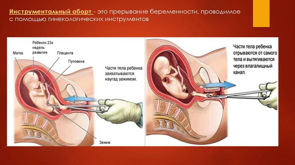 Аборт и половая жизнь | когда можно заниматься сексом после аборта? - probirka.org