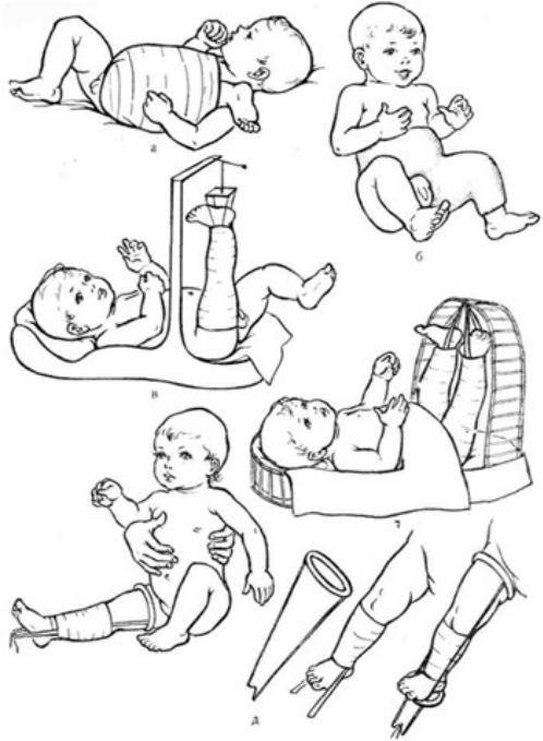 Важно: родителям о переломе ключицы у новорожденных
