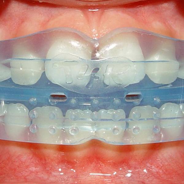 Пластины для выравнивания зубов: преимущества и недостатки