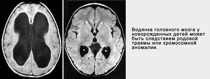 Субдуральные гематомы головного мозга — симптомы и способы лечения гематом головного мозга в клинике целт