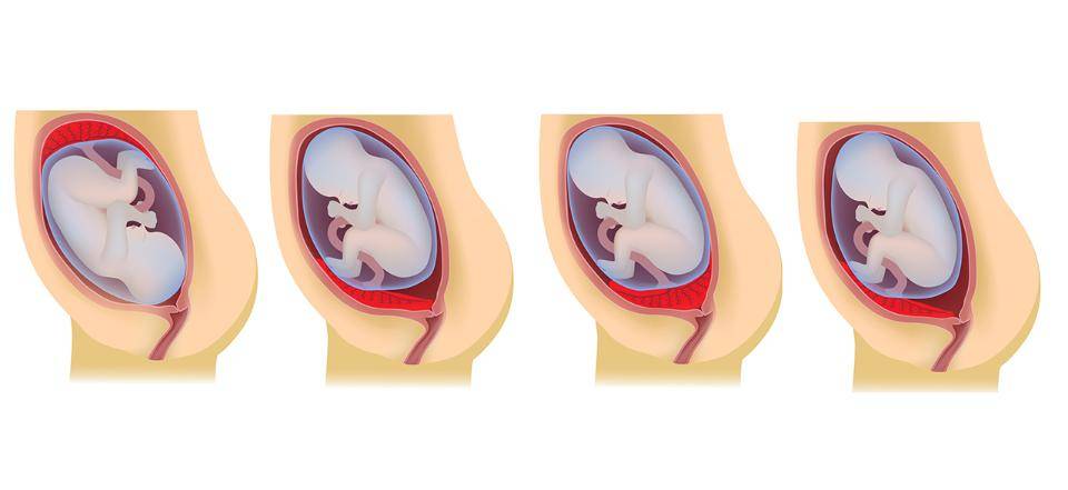 Плацента по передней стенке матки при беременности