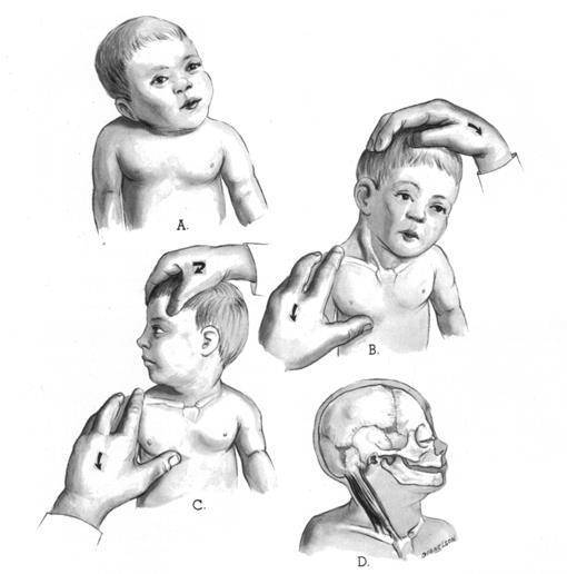 Профилактический и лечебный массаж ребенку при кривошее