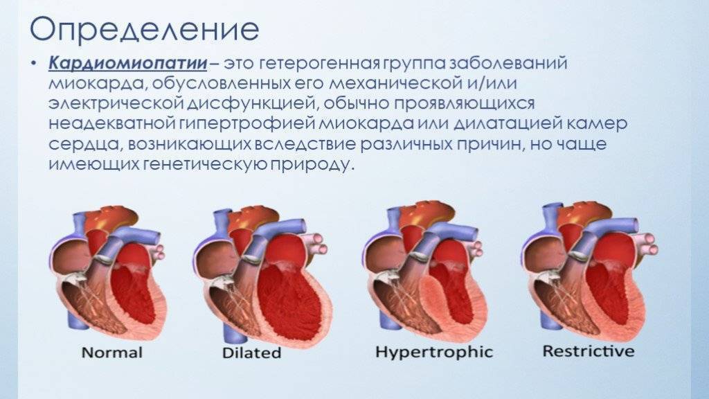 Дилатационная кардиомиопатия / заболевания / клиника эксперт