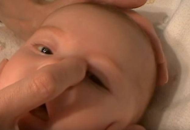 Массаж при дакриоцистите у новорожденных: как правильно делать слезного канала у грудничков