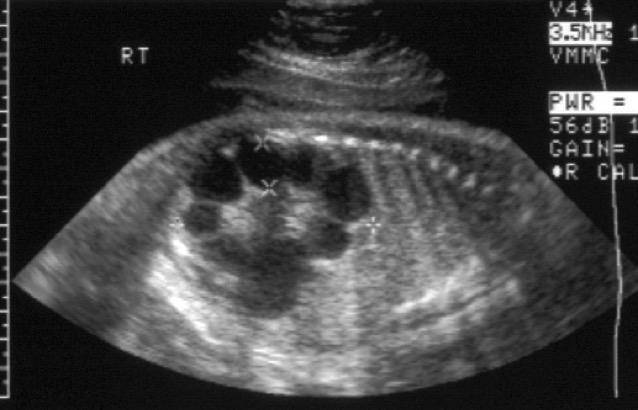 Пиелонефрит при беременности (болят почки)
