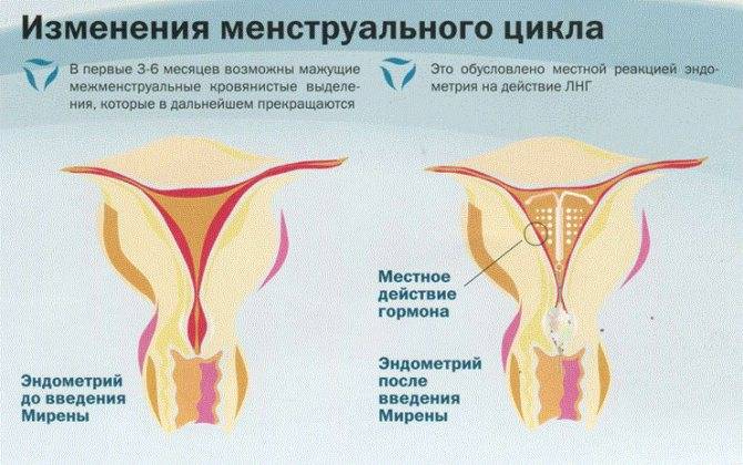 Аденомиоз матки: что это и как лечить - статья репродуктивного центра «за рождение»