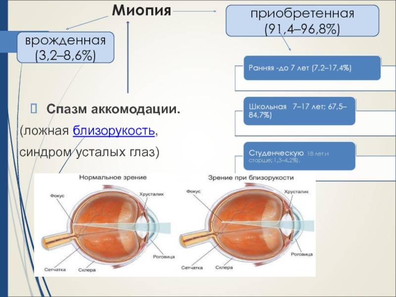 Признаки близорукости у детей - энциклопедия ochkov.net