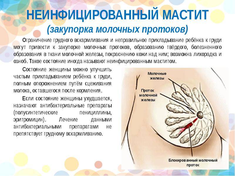 Лактостаз (застой молока): симптомы, лечение — online-diagnos.ru
