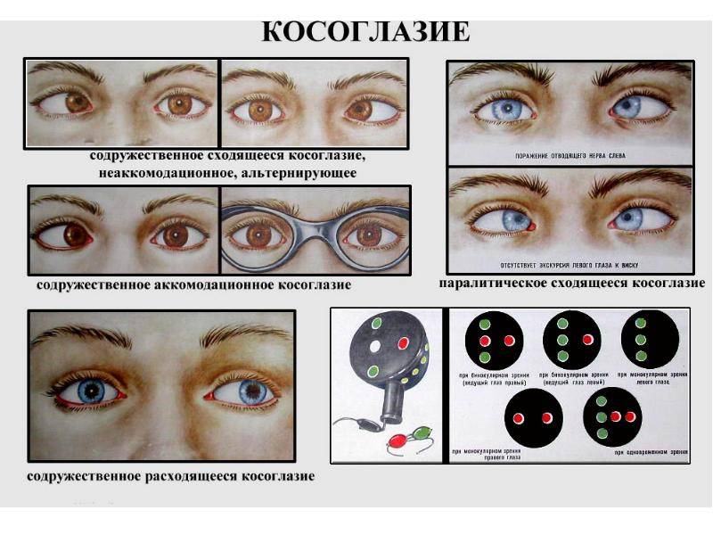 Косоглазие у детей (у ребенка): причины, лечение, операция - moscoweyes.ru - сайт офтальмологического центра "мгк-диагностик"