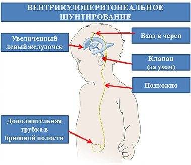 Кровоизлияние в желудочки головного мозга