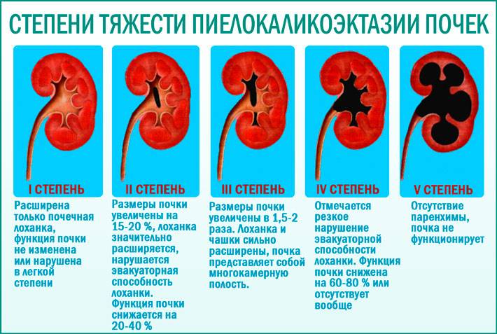Если при ультразвуковом исследовании найдено расширение почечных лоханок (пиелоэктазия)